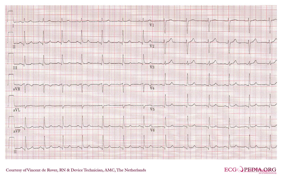 AMC Case 103 - ECGpedia