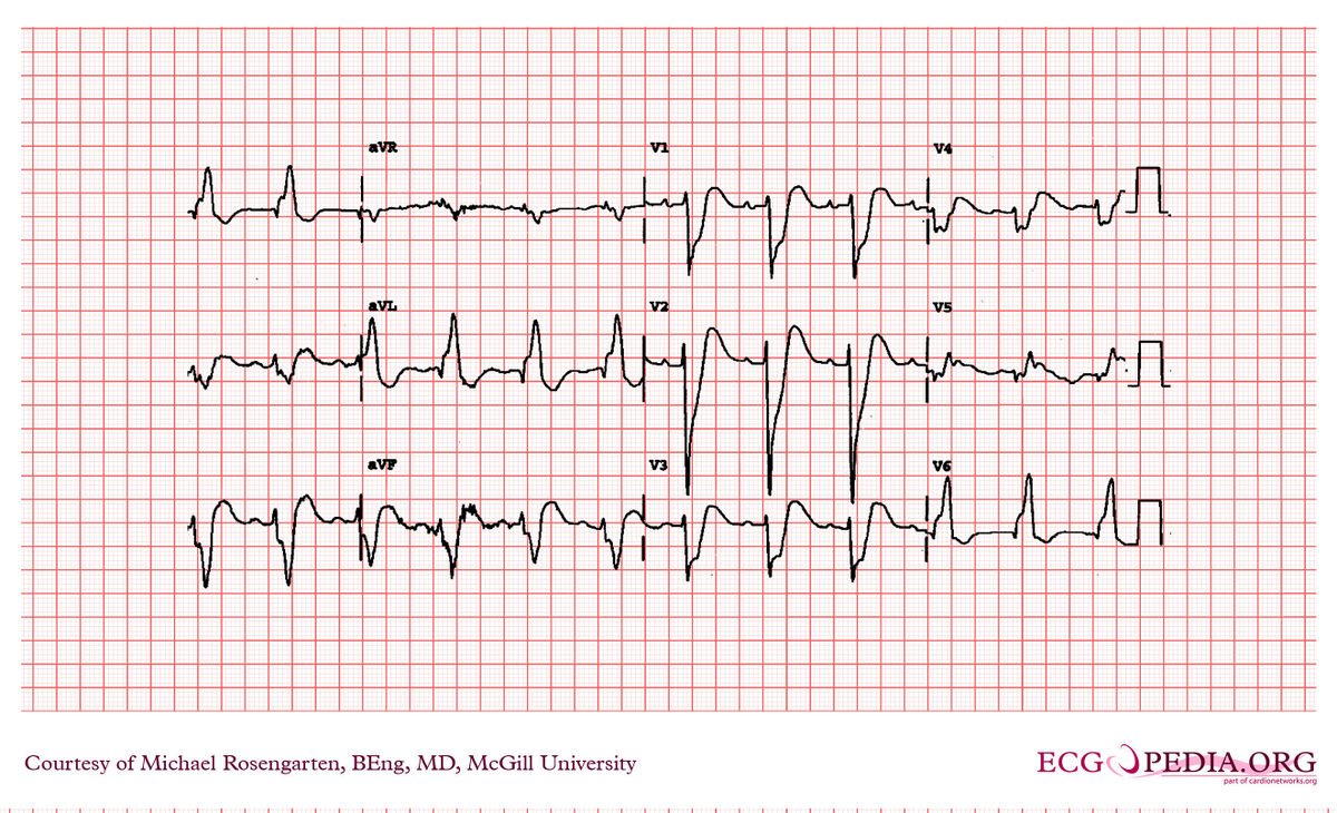 File:E000702.jpg - ECGpedia