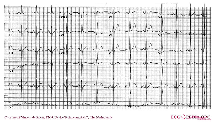 AMC Case 229 - ECGpedia