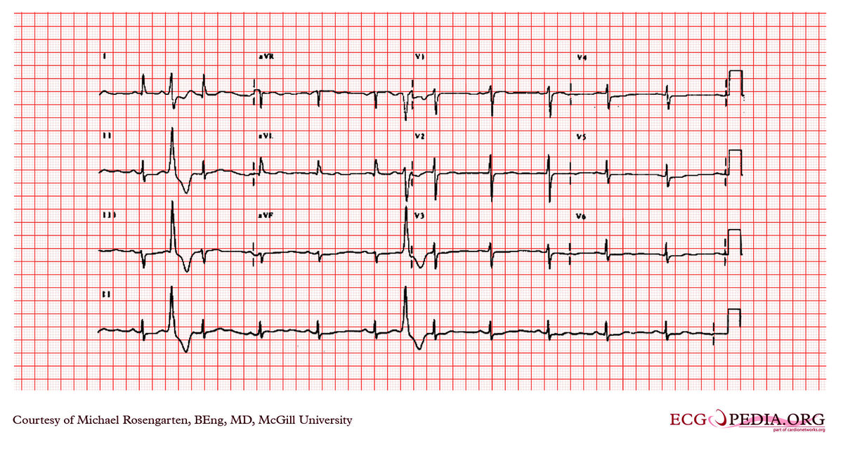 McGill Case 81 - ECGpedia