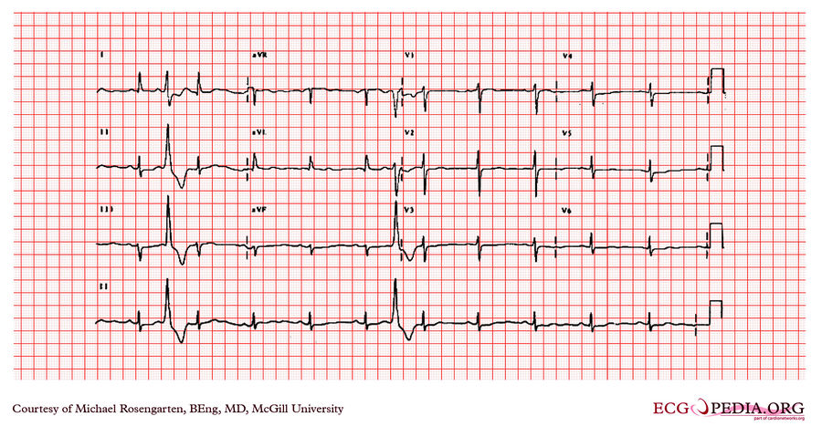 McGill Case 81 - ECGpedia