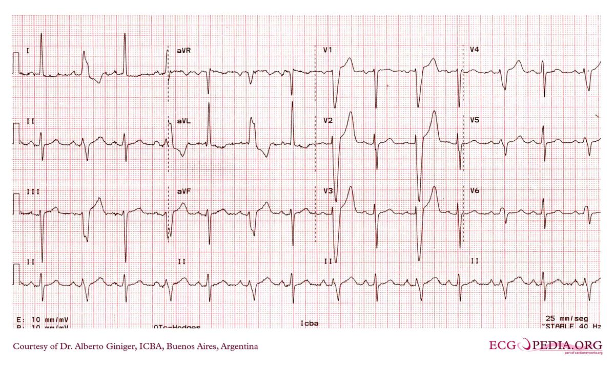 ICBA34 - ECGpedia