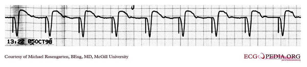 McGill Case 131 - ECGpedia