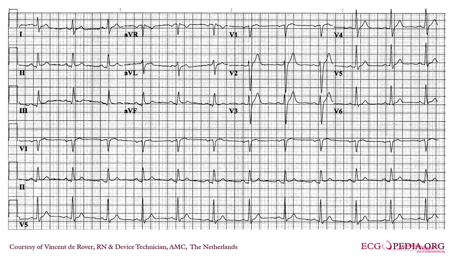 AMC Case 228 - ECGpedia