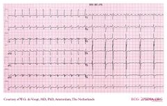 De Voogt ECG Archive - Supraventricular Rhythms - SSS - ECGpedia