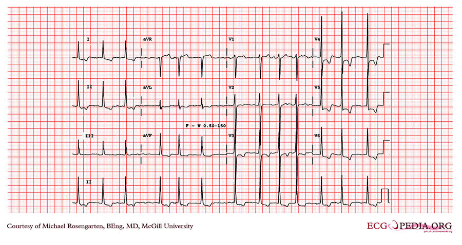 McGill Case 291 - ECGpedia