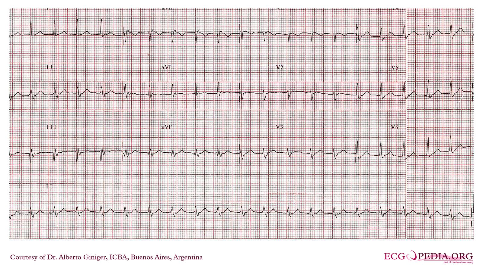 File:ICBA00016.jpg - ECGpedia