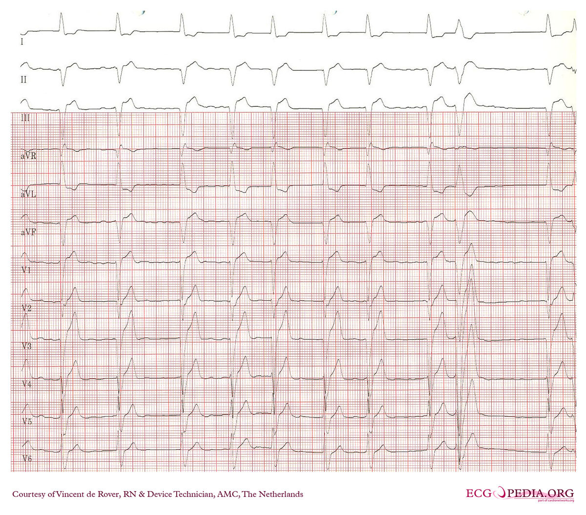 Amc Case 116 Ecgpedia