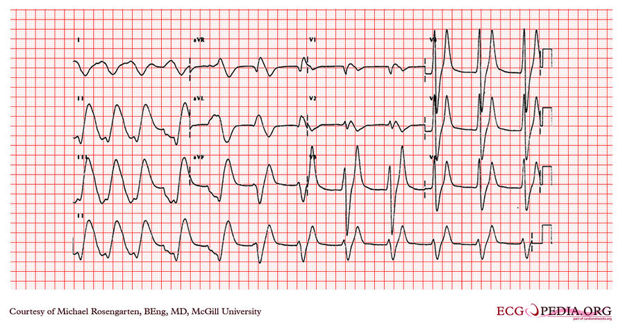 McGill Case 298 - ECGpedia