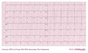 De Voogt ECG Archive - Electrolyte Disorders - ECGpedia