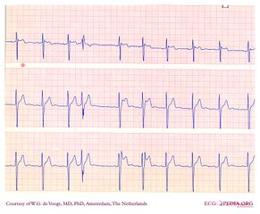 File:DVA2102.jpg - ECGpedia