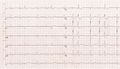 A patient with hypokalemia, prominent QT prolongation. Not the extrasystoles originating from the prolonged T/U wave. This patient definitely needs rhythm monitoring
