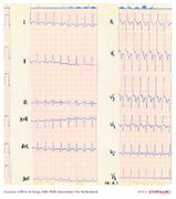 De Voogt ECG Archive - Ventricular Arrhythmias - ECGpedia