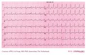 De Voogt ECG Archive - Supraventricular Rhythms - Atrial tachycardia ...