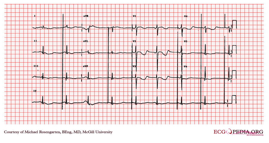 McGill Case 280 - ECGpedia