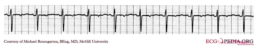 McGill Case 299 - ECGpedia