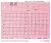 De Voogt ECG Archive - Electrolyte Disorders - ECGpedia