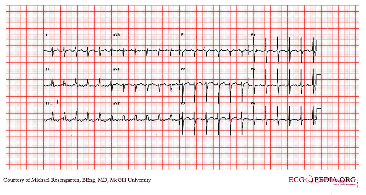 McGill Case 66 - ECGpedia