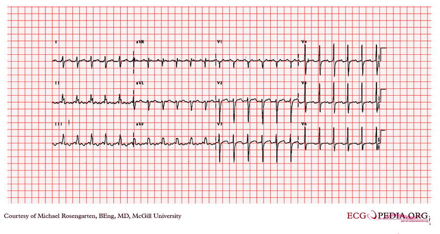 Mcgill Case 66 - Ecgpedia