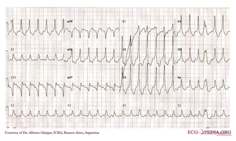 ICBA47 - ECGpedia