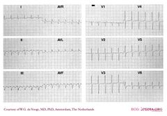 De Voogt Ecg Archive - Supraventricular Rhythms - Atrial Flutter - Ecgpedia