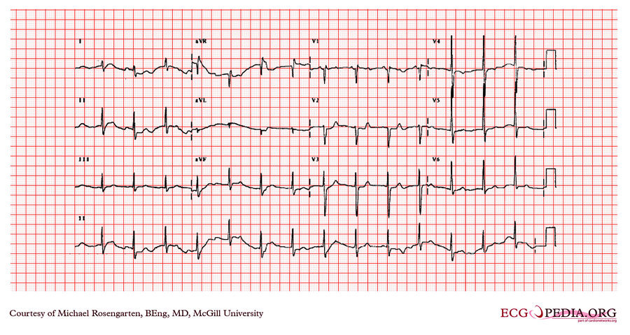 McGill Case 60 - ECGpedia