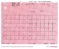 De Voogt ECG Archive - Electrolyte Disorders - ECGpedia