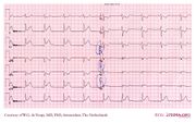 De Voogt ECG Archive - Myocardial Infarction - Inferior - ECGpedia