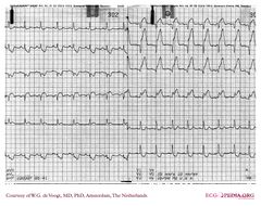 De Voogt ECG Archive - Myocardial Infarction - Anterior - ECGpedia