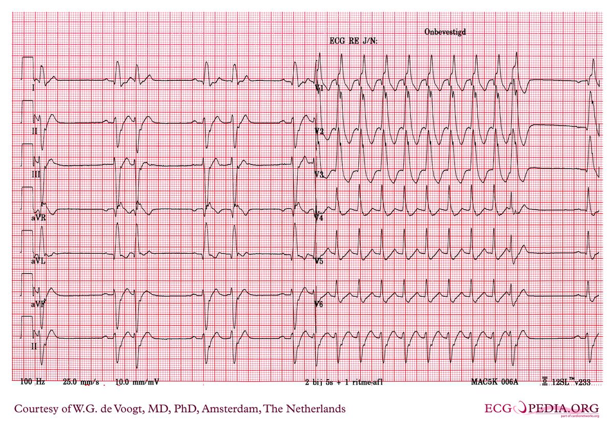 File:dva0334.jpg - Ecgpedia