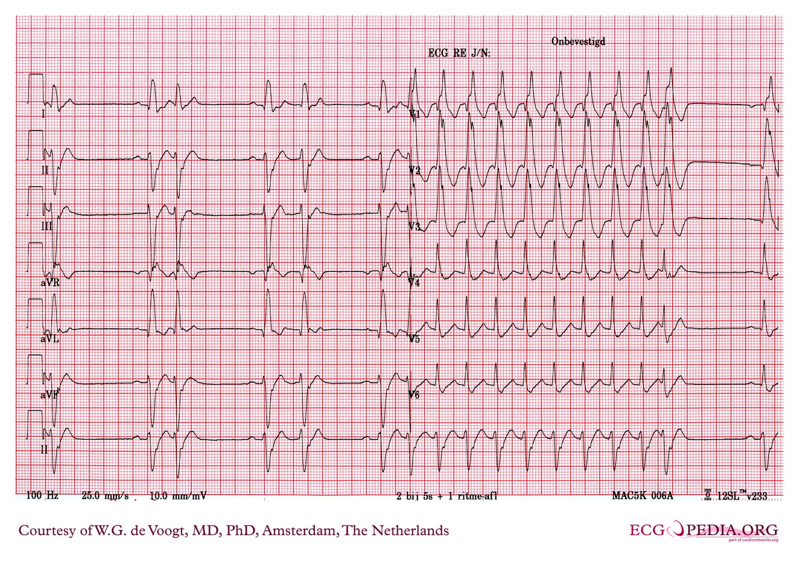 File:DVA0334.jpg - ECGpedia