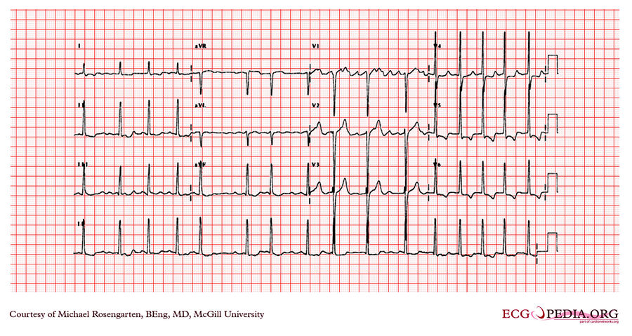 McGill Case 51 - ECGpedia