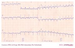 De Voogt ECG Archive - Supraventricular Rhythms - AVNRT - ECGpedia