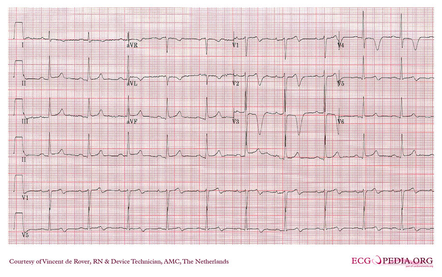 AMC Case 26 - ECGpedia