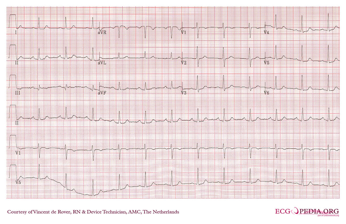 AMC Case 166 - ECGpedia