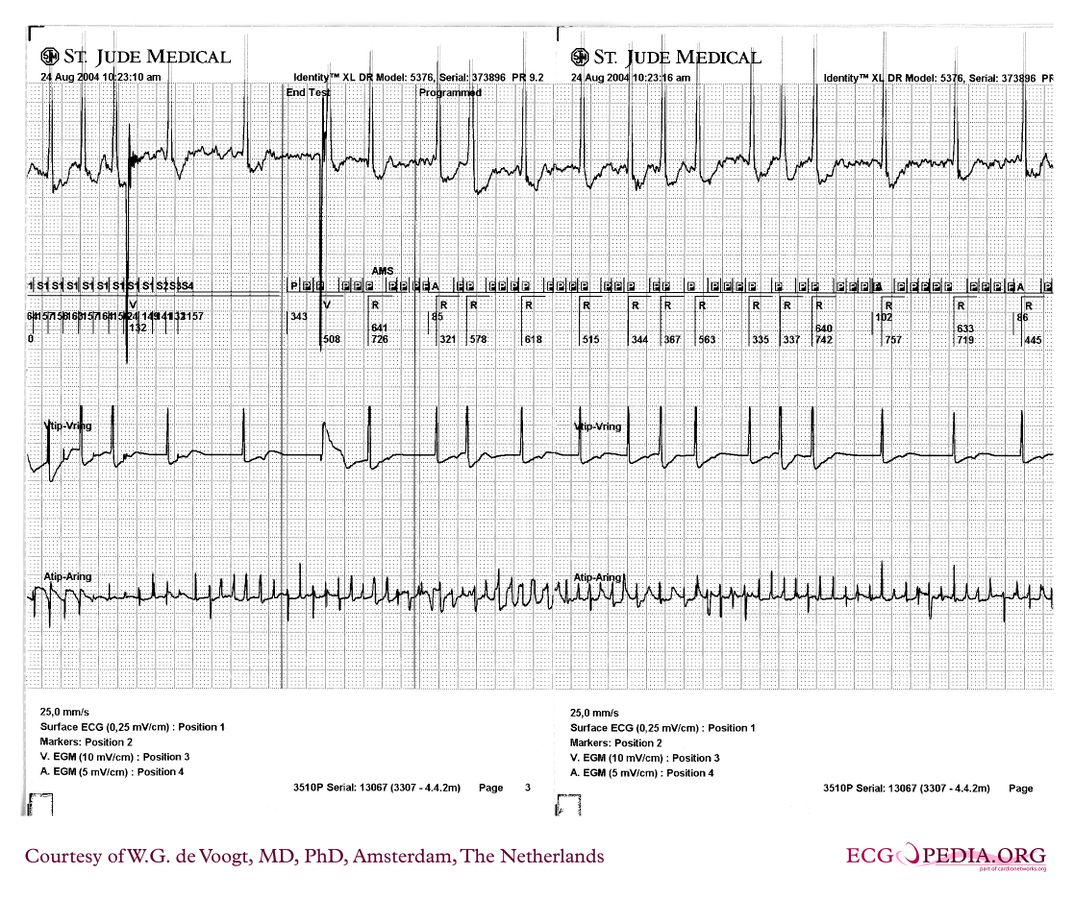 File:DVA1082.jpg - ECGpedia