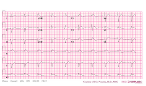 De-Brugada syndrome type1 example2.png