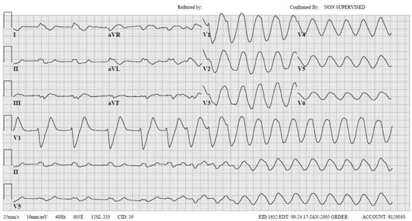 Puzzle 2005 11 428 - Answer - ECGpedia