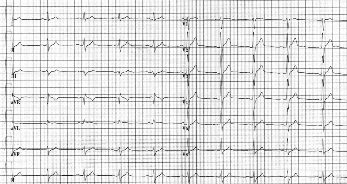 File:Puzzle 2006 1 33 fig1.jpg - ECGpedia