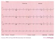 De Voogt ECG Archive - Supraventricular Rhythms - Atrial tachycardia ...