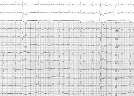 Puzzle 2007 1 33 Answer - ECGpedia