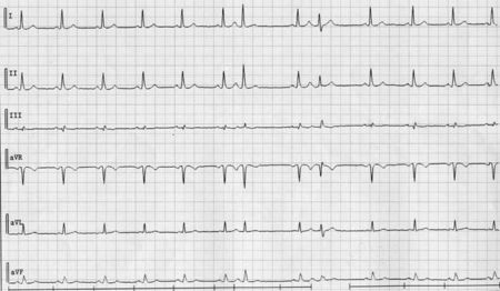 Wide Complexes Intervening Regular Sinus Rhythm - 3 - ECGpedia