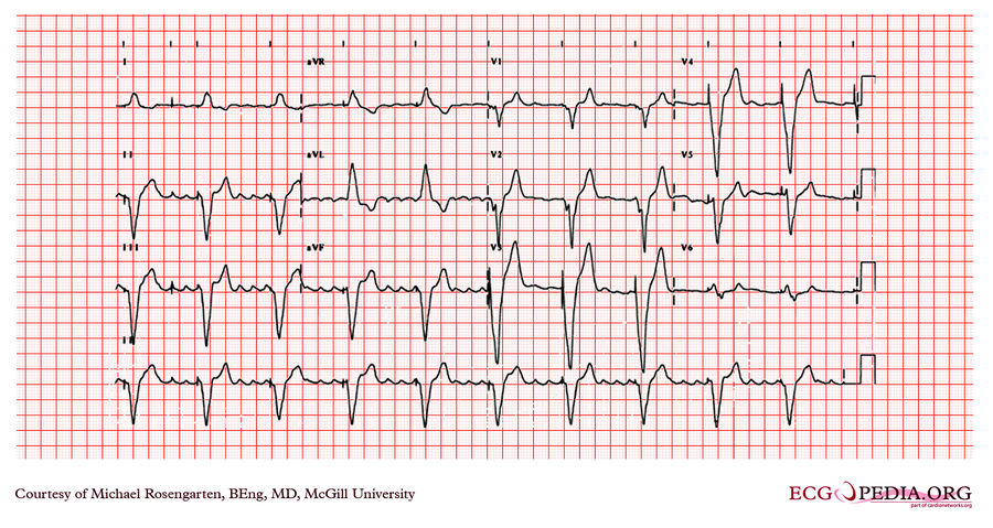 McGill Case 139 - ECGpedia