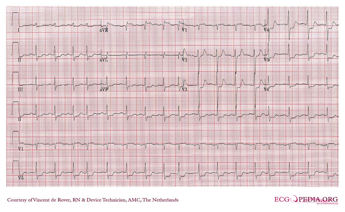 File:E000374.jpg - ECGpedia