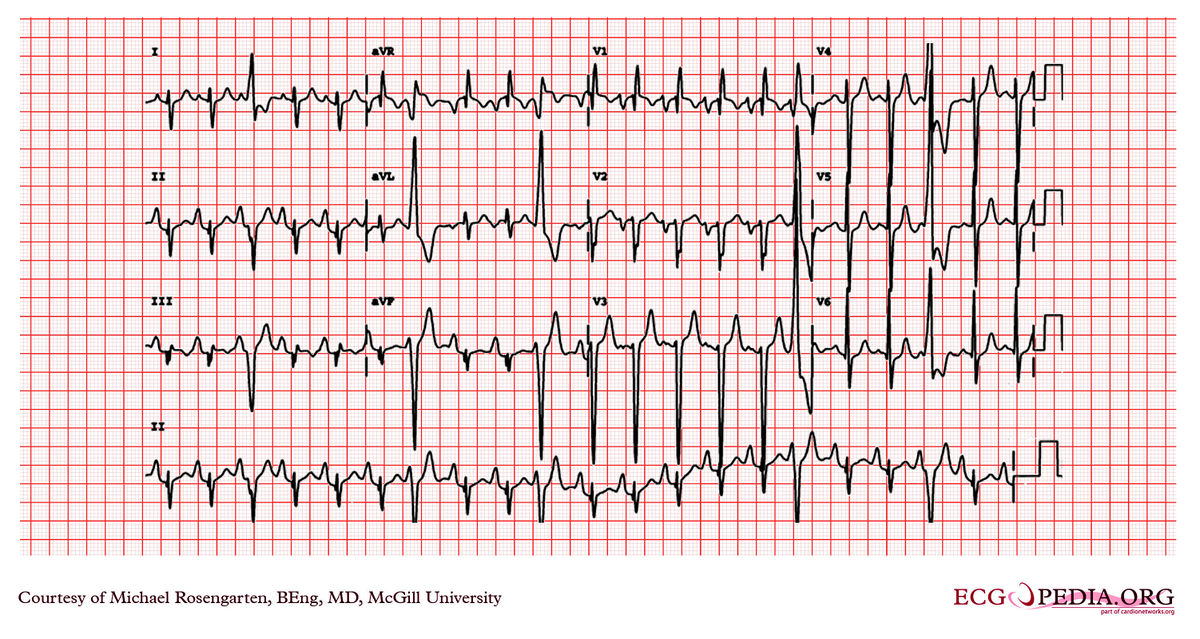 McGill Case 23 - ECGpedia