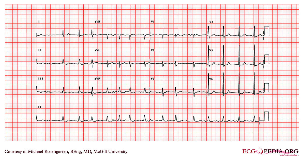 McGill Case 52 - ECGpedia