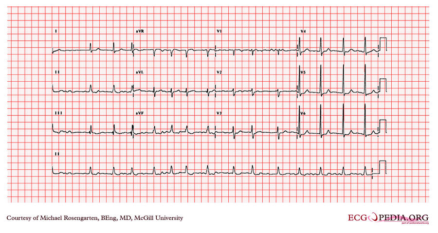 McGill Case 52 - ECGpedia