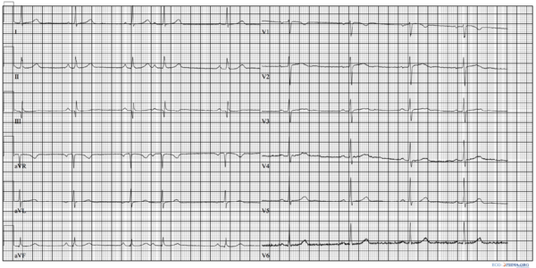 Atrial Premature Complexes Ecgpedia 6684