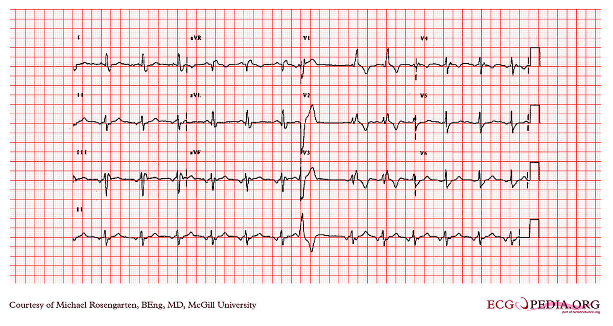 McGill Case 18 - ECGpedia