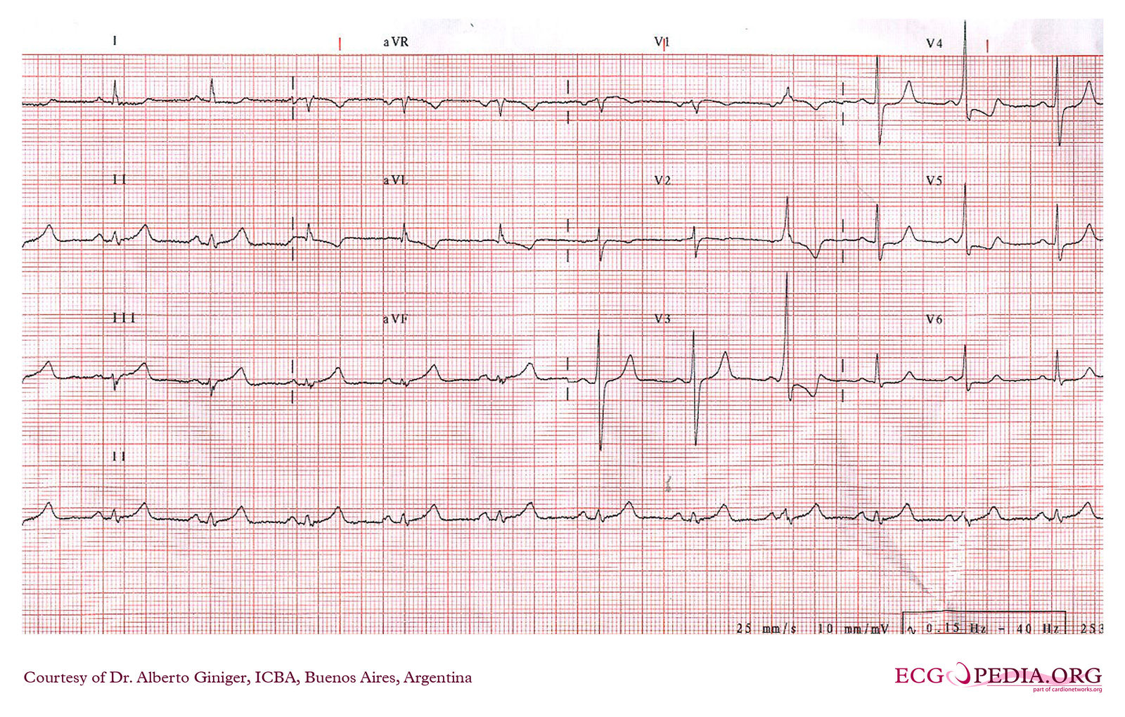 File:ICBA00023.jpg - ECGpedia